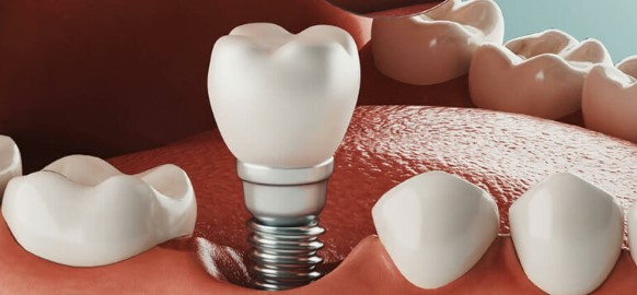 Caring for Your Dental Implants: Tips for Long-Term Success