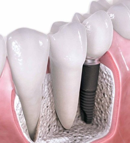 Caring For Your Dental Implants Tips For LongTerm Success, Dental Implant Care A Guide to LongTerm Success, Nurturing Your Dental Implants Tips For Lifelong Health, Maintaining Dental Implants Strategies for LongTerm Success, LongTerm Success with Dental Implant Care, Dental Implant Maintenance Ensuring LongTerm Success, Expert Tips for Caring for Dental Implants, Dental Implant Longevity Tips For Success, Dental Implant Aftercare Ensuring LongTerm Success, Dental Implant Health Tips For LongTerm Success, Dental Implant Wellness A Guide to LongTerm Success, Preserving Dental Implants Tips For LongTerm Success, Dental Implant Best Practices LongTerm Success Tips, Dental Implant Strategies for LongTerm Success, Dental Implant Care and LongTerm Success, Ensuring LongTerm Success for Dental Implants, Dental Implant Maintenance A Key to LongTerm Success, Tips for Dental Implant Longevity and Success, Dental Implant Success LongTerm Care Tips, Dental Implant Success Tips for LongTerm Maintenance, LongTerm Dental Implant Care and Success, Dental Implant Maintenance for LongTerm Success, Dental Implant Health and LongTerm Success, Dental Implant Tips for Lifelong Success, Dental Implant Guide for LongTerm Success